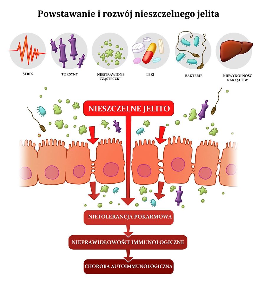 http://profmedika.pl/zespol-nieszczelnego-jelita/