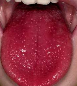 red-spots-on-tongue-pictures